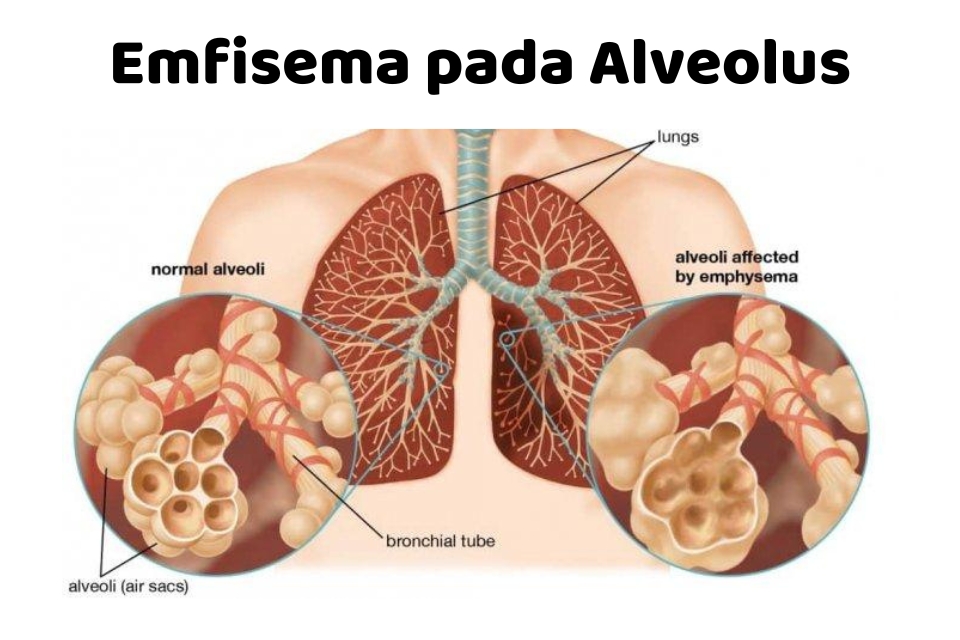 Gambar Alveolus - Emfisema Alveolus